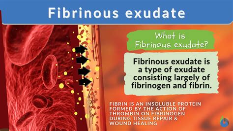 Fibrinous Exudate Definition And Examples Biology Online Dictionary