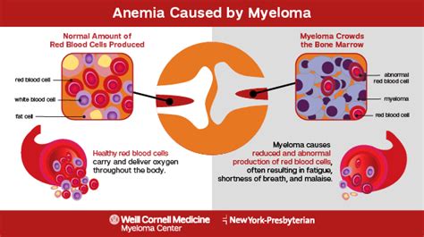 Myeloma Signs And Symptoms Myeloma Center
