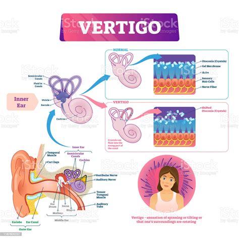 The bony labyrinth, a cavity in the temporal bone, is divided into three sections: Vertigo Vector Illustration Labeled Medical Vestibular Ear ...