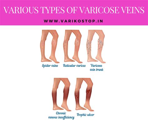Various Types Of Varicose Veins Varikostop Cream