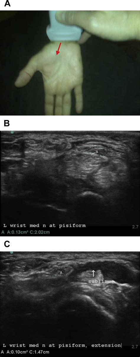 Ultrasound Imaging Of The Carpal Tunnel In A Patient With Cts Motion