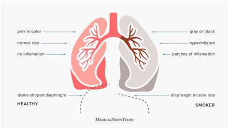 smoker s lungs vs healthy lungs facts pictures and more