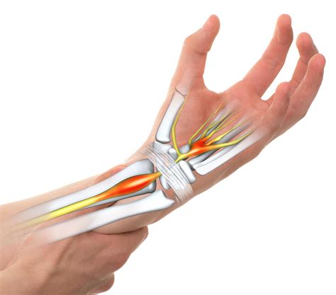 Carpal Tunnel Syndrome Specialist Palm Harbor Fl Orthopedic