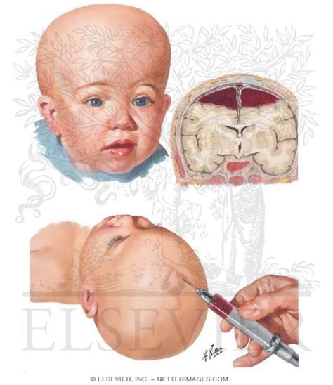 Subdural Hematoma Infant