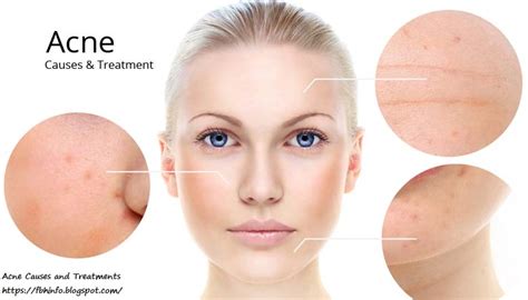 Acne Causes And Treatments Fitness Beauty And Health