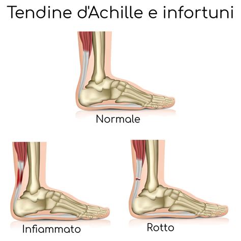 Tendinopatia D Achille Sintomi Cause E Come Trattarla Maratone In The