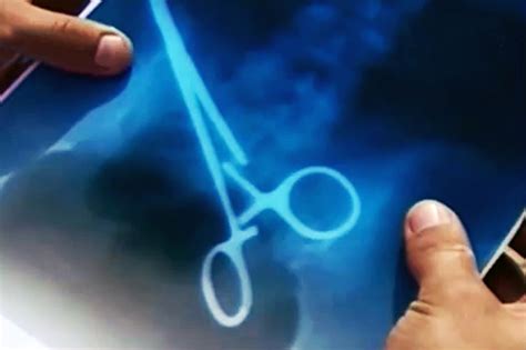 Scissors Removed After 3 Years In Womans Body