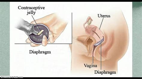 Diaphragm Contraceptive Youtube