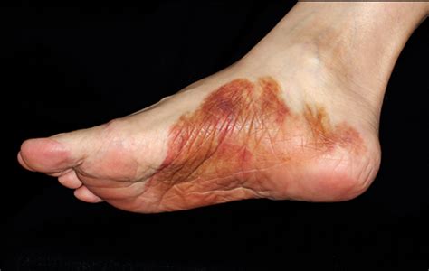 Hyperpigmented Patches On Shins Palms And Soles—quiz Case
