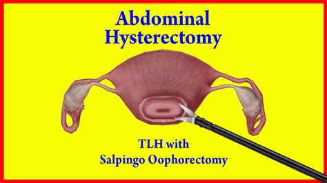 Tlh How To Do Total Abdominal Hysterectomy With Salpingo Oophorectomy Procedure By Dr Neena