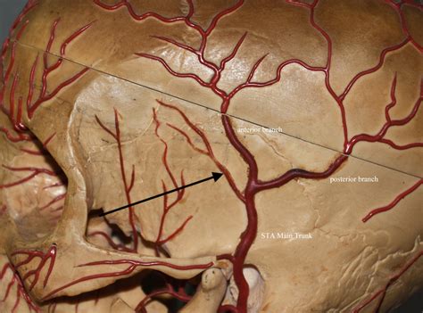 Enlarged Accessort Branch Of The Superficial Temporal Artery Anatomy