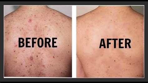 Bacne Everything You Should Know About Back Acne Treatments