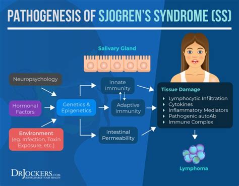 Sjogrens Syndrome Symptoms Causes And Natural Support Strategies