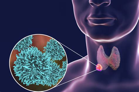 The thyroid is a small gland located below the voice box in the front of the if cells in the thyroid gland grow uncontrollably, they form a nodule (tumor). Wording Used May Affect Thyroid Cancer Patients' Anxiety ...