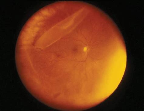 The retina is a layer of tissue that lines the inside of your eye. Giant Retinal Tears: Surgical Approach | Ento Key