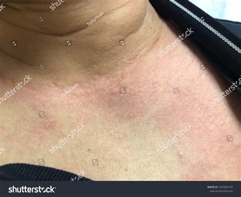 Urticarial Rash Neck Case Allergy Rabies Stock Photo 1597693135