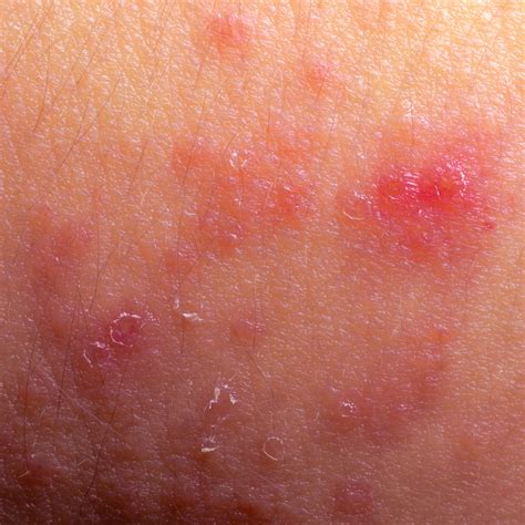 Washington Dc Allergist Eczema Atopic Dermatitis
