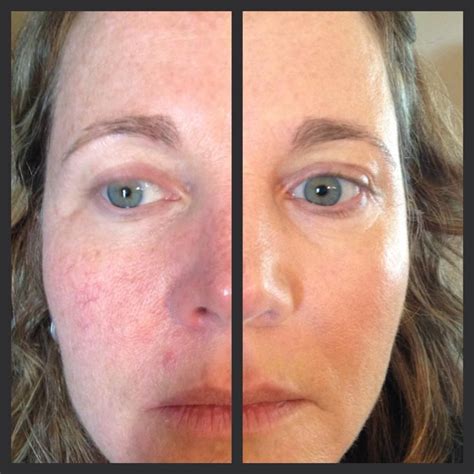 How To Get Rid Of Rosacea One Product Motives Mua Amy Mcglinchey
