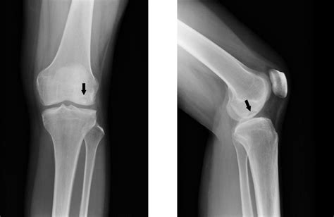 Displaced Osteochondral Fracture Of The Lateral Femoral Condyle My XXX Hot Girl