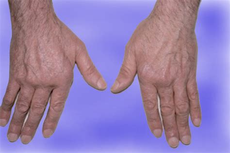 Sle Systemic Lupus Erythematosus Hand Surgery Resource