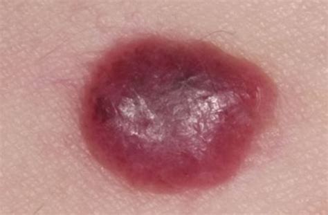 Blood Blisters On Breast Treat Cure Fast