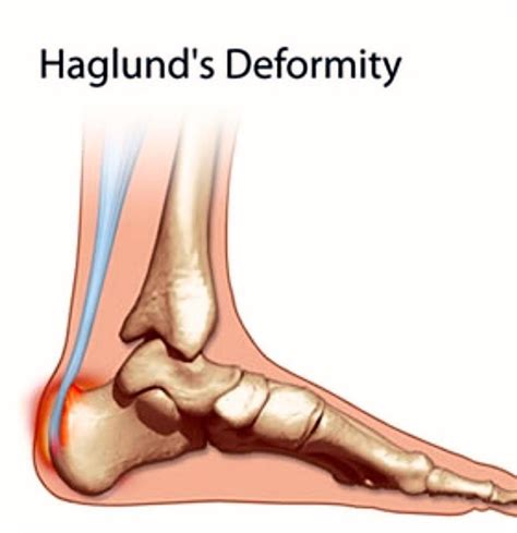 Haglunds Deformity A Bony Enlargement Which Is Painful The Star