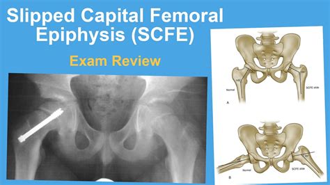 Slipped Capital Femoral Epiphysis Exam Review Rachel Goldstein Md