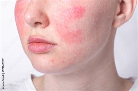 Rosacea Couperose Redness Skin Red Spots On Cheeks Young Woman With