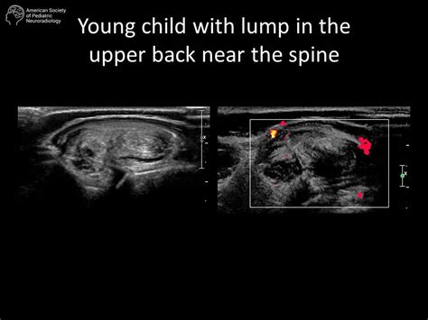 Young Child With Lump In The Upper Back Near The Spine American