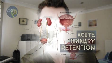 Acute Urinary Retention What Is It And What Should You Do YouTube
