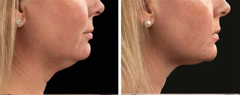 Coolsculpting Double Chin London Premier Laser Clinic