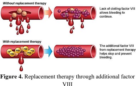 Treatment Of Haemophilia A By Replacement Therapy Using Factor Viii