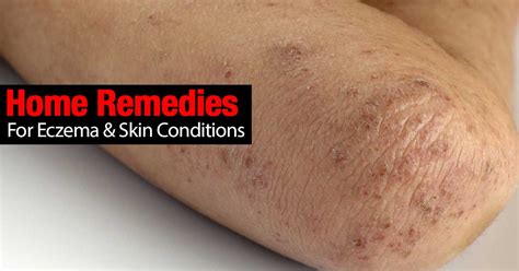 Home Remedies For Eczema And Skin Conditions
