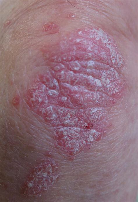 Psoriasis Obgyn Key