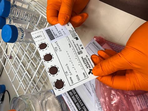 Dried Blood Spot Sampling Offers An Inexpensive Way To Widen Access To