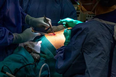 Umbilical Hernia Repair Umbilical Hernia Treatment Umbilical Hernia Surgery UGIRS Melbourne