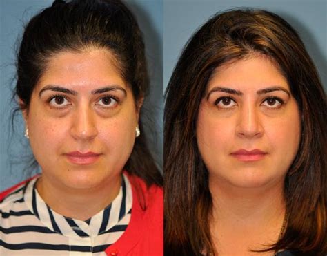 Blepharoplasty Photos Chevy Chase Md Patient 8918