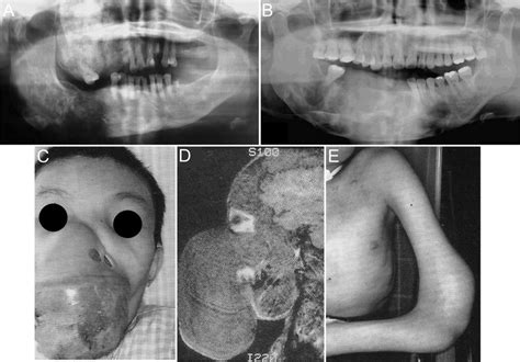 Clinical Appearance Of Monostotic Fibrous Dysplasia Mfd And