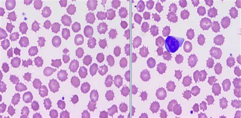 Test 1 Hematopathology