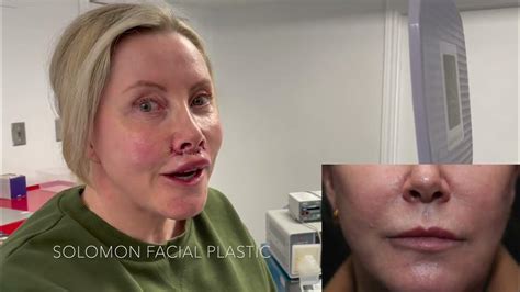 upper lip lift surgery for lip augmentation by dr philip solomon in toronto youtube
