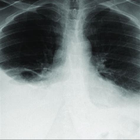 Chest X Ray Showing Bilateral Blunting Of Costophrenic Angle