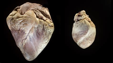 K Corbin Biological Heart Valve Replacements