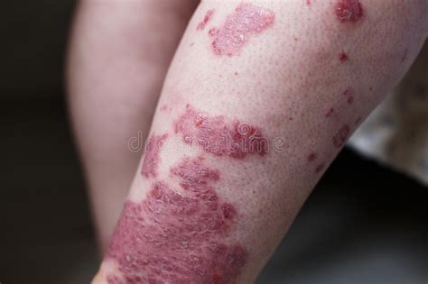Allergic Rash Dermatitis Eczema Skin On Leg Of Patient