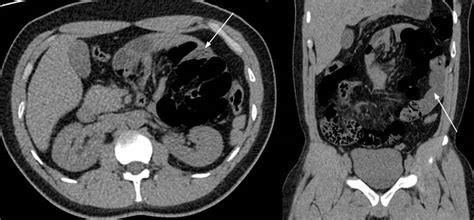 Congenital Paraduodenal Hernia A Case Report