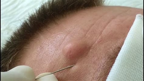 epidermal sebaceous cyst