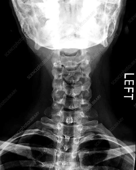 Cervical Spine X Ray Tewsright