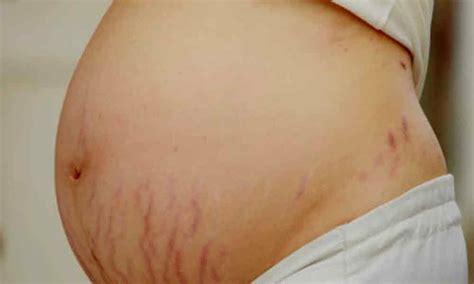 how to manage stretch marks during and post pregnancy