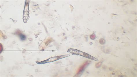 Demodectic Mange Mites Demodex Demodex Canis Seen Under Microscope