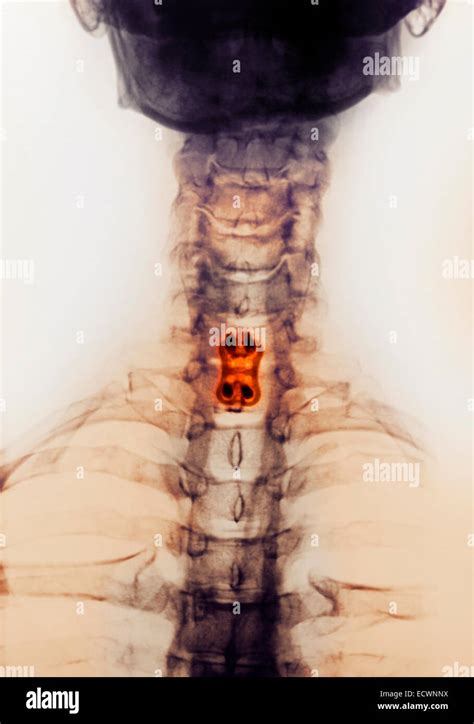 Cervical Neck X Ray Showing Spinal Fusion Stock Photo Alamy