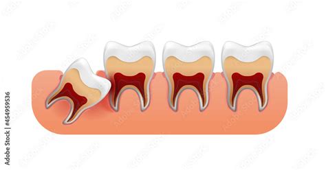 Impacted Wisdom Tooth Wisdom Teeth Eruption Problems Inflamed Gums